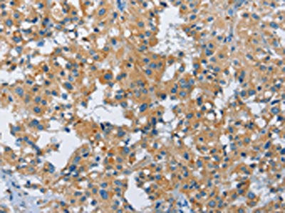 The image on the left is immunohistochemistry of paraffin-embedded Human thyroid cancer tissue using the antibody Antibody) at dilution 1/40, on the right is treated with fusion protein. (Original magnification: ×200)Rabbit anti-Human FGF9 Polyclonal Antibody