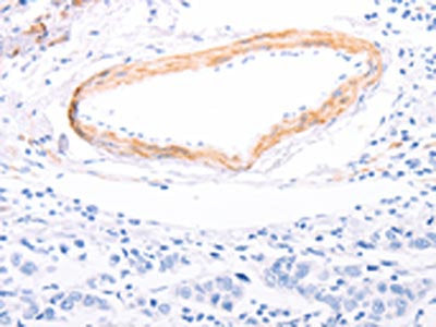 The image on the left is immunohistochemistry of paraffin-embedded Human breast cancer tissue using the antibody Antibody) at dilution 1/80, on the right is treated with fusion protein. (Original magnification: ×200)Rabbit anti-Human TPM1 Polyclonal Antibody
