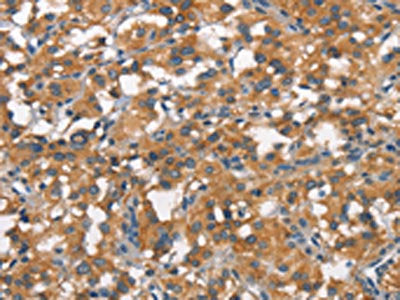 The image on the left is immunohistochemistry of paraffin-embedded Human thyroid cancer tissue using ALCAM Antibody(ALCAM Antibody) at dilution 1/25, on the right is treated with synthetic peptide. (Original magnification: ×200)Rabbit anti-Human ALCAM Polyclonal Antibody