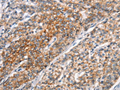 The image on the left is immunohistochemistry of paraffin-embedded Human prostate cancer tissue using the antibody Antibody) at dilution 1/25, on the right is treated with synthetic peptide. (Original magnification: ×200)Rabbit anti-Human ALCAM Polyclonal Antibody