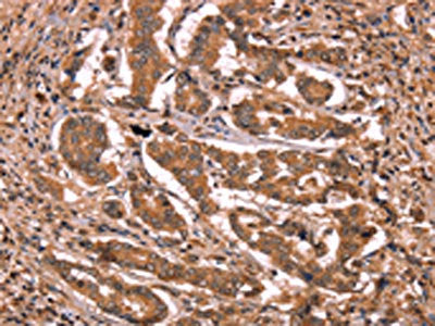 The image on the left is immunohistochemistry of paraffin-embedded Human breast cancer tissue using the antibody Antibody) at dilution 1/15, on the right is treated with synthetic peptide. (Original magnification: ×200)