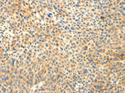 The image on the left is immunohistochemistry of paraffin-embedded Human liver cancer tissue using TRAF3IP2 Antibody(TRAF3IP2 Antibody) at dilution 1/30, on the right is treated with fusion protein. (Original magnification: ×200)Rabbit anti-Human TRAF3IP2 Polyclonal Antibody