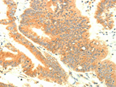 The image on the left is immunohistochemistry of paraffin-embedded Human colon cancer tissue using the antibody Antibody) at dilution 1/30, on the right is treated with fusion protein. (Original magnification: ×200)Rabbit anti-Human TRAF3IP2 Polyclonal Antibody