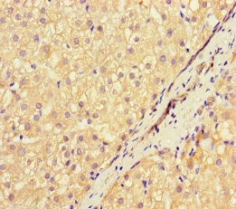 Immunohistochemistry of paraffin-embedded human liver cancer using the antibody at dilution of 1:100Rabbit anti-Human NEU1 Polyclonal Antibody
