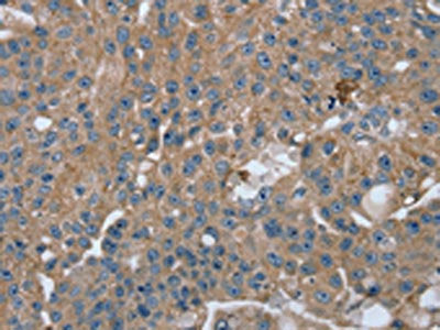 The image on the left is immunohistochemistry of paraffin-embedded Human breast cancer tissue using RAB9A Antibody(RAB9A Antibody) at dilution 1/20, on the right is treated with fusion protein. (Original magnification: ×200)Rabbit anti-Human RAB9A Polyclonal Antibody