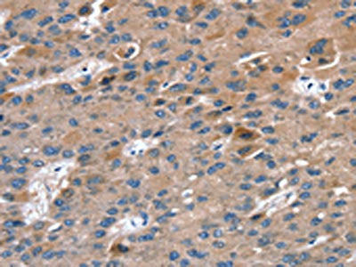 The image on the left is immunohistochemistry of paraffin-embedded Human liver cancer tissue using the antibody Antibody) at dilution 1/20, on the right is treated with fusion protein. (Original magnification: ×200)Rabbit anti-Human RAB9A Polyclonal Antibody