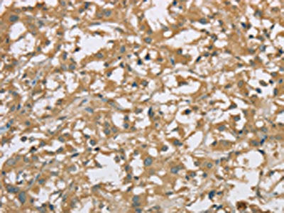 The image on the left is immunohistochemistry of paraffin-embedded Human thyroid cancer tissue using EIF3F Antibody(EIF3F Antibody) at dilution 1/25, on the right is treated with fusion protein. (Original magnification: ×200)Rabbit anti-Human EIF3F Polyclonal Antibody
