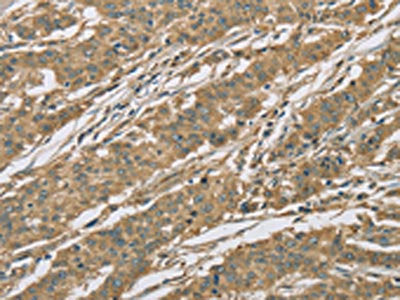 The image on the left is immunohistochemistry of paraffin-embedded Human gastic cancer tissue using the antibody Antibody) at dilution 1/25, on the right is treated with fusion protein. (Original magnification: ×200)Rabbit anti-Human EIF3F Polyclonal Antibody