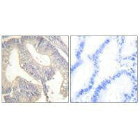 Immunohistochemical analysis of paraffin-embedded human colon carcinoma tissue using Gastrin antibody.Rabbit anti-Human GAST Polyclonal Antibody