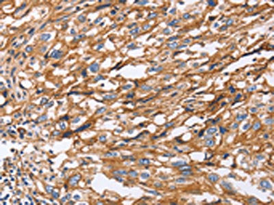 The image on the left is immunohistochemistry of paraffin-embedded Human esophagus cancer tissue using ITGB1 Antibody(ITGB1 Antibody) at dilution 1/50, on the right is treated with fusion protein. (Original magnification: ×200)