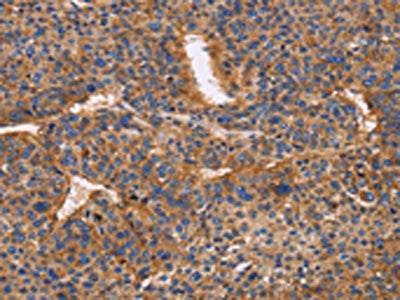 The image on the left is immunohistochemistry of paraffin-embedded Human liver cancer tissue using the antibody Antibody) at dilution 1/50, on the right is treated with fusion protein. (Original magnification: ×200)