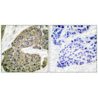 Immunohistochemical analysis of paraffin-embedded human breast carcinoma tissue using Keratin 5 antibody.