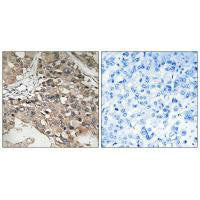Immunohistochemistry analysis of paraffin-embedded human breast carcinoma tissue using MAP3K7 (Ab-187) antibody.