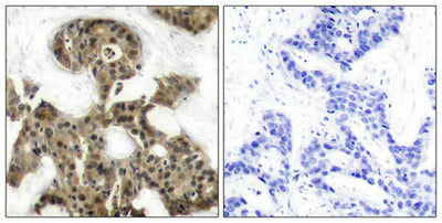 Immunohistochemical analysis of paraffin-embedded human breast carcinoma tissue using 4E-BP1(Ab-45) Antibody(left) or the same antibody preincubated with blocking peptide(right).Rabbit anti-Human EIF4EBP1 Polyclonal Antibody