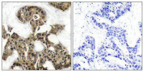 Immunohistochemical analysis of paraffin-embedded human breast carcinoma tissue using 4E-BP1(Ab-45) Antibody(left) or the same antibody preincubated with blocking peptide(right).Rabbit anti-Human EIF4EBP1 Polyclonal Antibody