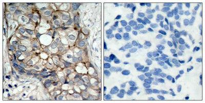 Immunohistochemical analysis of paraffin-embedded human breast carcinoma tissue using EGFR(Ab-1070) Antibody(left) or the same antibody preincubated with blocking peptide(right).Rabbit anti-Human EGFR Polyclonal Antibody