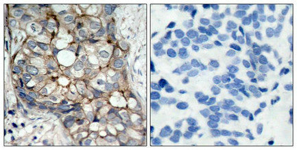 Immunohistochemical analysis of paraffin-embedded human breast carcinoma tissue using EGFR(Ab-1070) Antibody(left) or the same antibody preincubated with blocking peptide(right).Rabbit anti-Human EGFR Polyclonal Antibody
