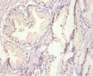 Immunohistochemistry of paraffin-embedded human prostate tissue using the antibody at dilution of 1:100Rabbit anti-Human MT1A Polyclonal Antibody