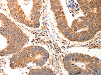 The image on the left is immunohistochemistry of paraffin-embedded Human colon cancer tissue using CCL17 Antibody(CCL17 Antibody) at dilution 1/60, on the right is treated with synthetic peptide. (Original magnification: ×200)Rabbit anti-Human CCL17 Polyclonal Antibody