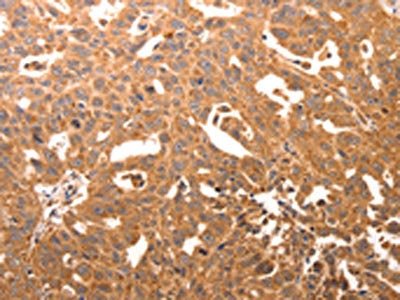 The image on the left is immunohistochemistry of paraffin-embedded Human ovarian cancer tissue using the antibody Antibody) at dilution 1/60, on the right is treated with synthetic peptide. (Original magnification: ×200)
