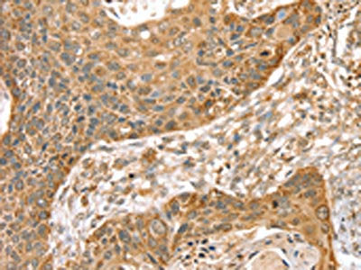 The image on the left is immunohistochemistry of paraffin-embedded Human esophagus cancer tissue using SMC4 Antibody(SMC4 Antibody) at dilution 1/35, on the right is treated with synthetic peptide. (Original magnification: ×200)Rabbit anti-Human SMC4 Polyclonal Antibody