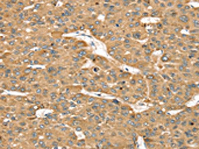 The image on the left is immunohistochemistry of paraffin-embedded Human liver cancer tissue using the antibody Antibody) at dilution 1/35, on the right is treated with synthetic peptide. (Original magnification: ×200)Rabbit anti-Human SMC4 Polyclonal Antibody
