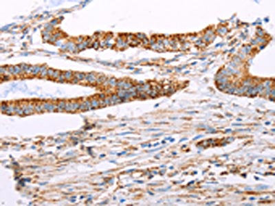The image on the left is immunohistochemistry of paraffin-embedded Human colon cancer tissue using the antibody Antibody) at dilution 1/15, on the right is treated with fusion protein. (Original magnification: ×200)