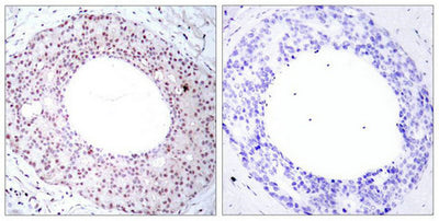 Immunohistochemical analysis of paraffin-embedded human breast carcinoma tissue using NFkB-p65(Phospho-Thr254) Antibody(left) or the same antibody preincubated with blocking peptide(right).Rabbit anti-Human RELA Polyclonal Antibody