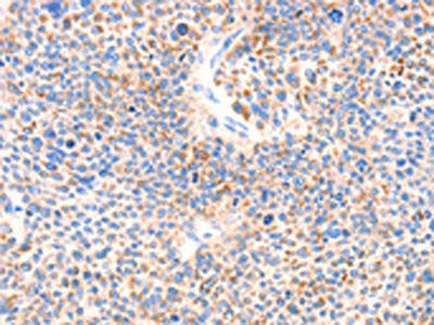 The image on the left is immunohistochemistry of paraffin-embedded Human liver cancer tissue using PAFAH2 Antibody(PAFAH2 Antibody) at dilution 1/80, on the right is treated with synthetic peptide. (Original magnification: ×200)Rabbit anti-Human PAFAH2 Polyclonal Antibody