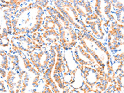 The image on the left is immunohistochemistry of paraffin-embedded Human thyroid cancer tissue using the antibody Antibody) at dilution 1/80, on the right is treated with synthetic peptide. (Original magnification: ×200)Rabbit anti-Human PAFAH2 Polyclonal Antibody