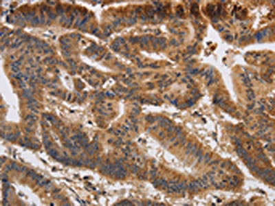 The image on the left is immunohistochemistry of paraffin-embedded Human colon cancer tissue using KCNK9 Antibody(KCNK9 Antibody) at dilution 1/40, on the right is treated with synthetic peptide. (Original magnification: ×200)