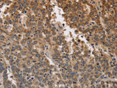 The image on the left is immunohistochemistry of paraffin-embedded Human liver cancer tissue using the antibody Antibody) at dilution 1/40, on the right is treated with synthetic peptide. (Original magnification: ×200)