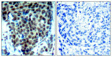 Immunohistochemical analysis of paraffin-embedded human breast carcinoma tissue using P38 MAPK(Phospho-Thr180) Antibody(left) or the same antibody preincubated with blocking peptide(right).