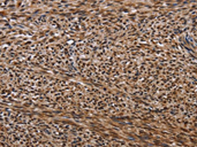 The image on the left is immunohistochemistry of paraffin-embedded Human sarcoma tissue using KIF1C Antibody(KIF1C Antibody) at dilution 1/60, on the right is treated with fusion protein. (Original magnification: ×200)