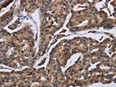 The image on the left is immunohistochemistry of paraffin-embedded Human breast cancer tissue using the antibody Antibody) at dilution 1/60, on the right is treated with fusion protein. (Original magnification: ×200)