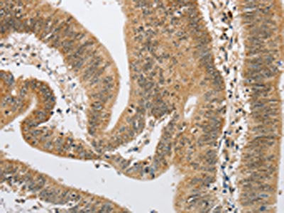 The image on the left is immunohistochemistry of paraffin-embedded Human colon cancer tissue using ARHGAP25 Antibody(ARHGAP25 Antibody) at dilution 1/40, on the right is treated with fusion protein. (Original magnification: ×200)Rabbit anti-Human ARHGAP25 Polyclonal Antibody