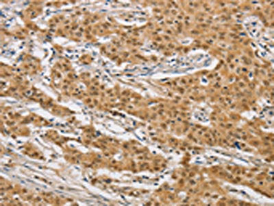 The image on the left is immunohistochemistry of paraffin-embedded Human gastic cancer tissue using the antibody Antibody) at dilution 1/40, on the right is treated with fusion protein. (Original magnification: ×200)Rabbit anti-Human ARHGAP25 Polyclonal Antibody