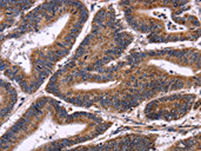 The image on the left is immunohistochemistry of paraffin-embedded Human colon cancer tissue using the antibody Antibody) at dilution 1/50, on the right is treated with fusion protein. (Original magnification: ×200)Rabbit anti-Human AMIGO2 Polyclonal Antibody