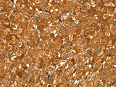 The image on the left is immunohistochemistry of paraffin-embedded Human liver cancer tissue using PYGM Antibody(PYGM Antibody) at dilution 1/30, on the right is treated with fusion protein. (Original magnification: ×200)Rabbit anti-Human PYGM Polyclonal Antibody
