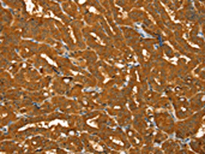 The image on the left is immunohistochemistry of paraffin-embedded Human thyroid cancer tissue using the antibody Antibody) at dilution 1/30, on the right is treated with fusion protein. (Original magnification: ×200)Rabbit anti-Human PYGM Polyclonal Antibody
