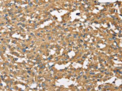 The image on the left is immunohistochemistry of paraffin-embedded Human thyroid cancer tissue using DCTN2 Antibody(DCTN2 Antibody) at dilution 1/25, on the right is treated with fusion protein. (Original magnification: ×200)Rabbit anti-Human DCTN2 Polyclonal Antibody