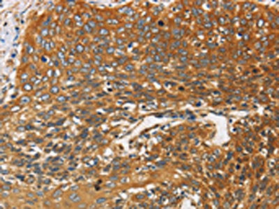 The image on the left is immunohistochemistry of paraffin-embedded Human cervical cancer tissue using the antibody Antibody) at dilution 1/25, on the right is treated with fusion protein. (Original magnification: ×200)Rabbit anti-Human DCTN2 Polyclonal Antibody