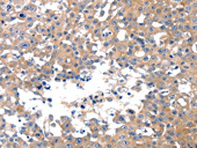 The image on the left is immunohistochemistry of paraffin-embedded Human breast cancer tissue using MAPK8 Antibody(MAPK8 Antibody) at dilution 1/50, on the right is treated with synthetic peptide. (Original magnification: ×200)