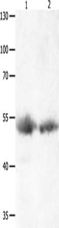 Gel: 8%SDS-PAGE, Lysate: 40 μg, Lane 1-2: Human lymphoma tissue, Human liver cancer tissue, Primary antibody: MAPK8 Antibody(MAPK8 Antibody) at dilution 1/1000, Secondary antibody: Goat anti rabbit IgG at 1/8000 dilution, Exposure time: 5 minutes