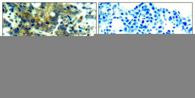 Immunohistochemical analysis of paraffin-embedded human breast carcinoma tissue using p70 S6 Kinase(Phospho-Ser411) Antibody(left) or the same antibody preincubated with blocking peptide(right).Rabbit anti-Human RPS6KB1 Polyclonal Antibody