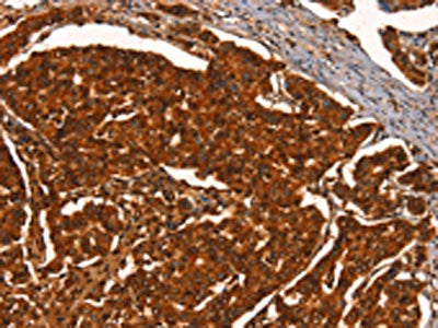 The image on the left is immunohistochemistry of paraffin-embedded Human breast cancer tissue using PRKD1 Antibody(PRKD1 Antibody) at dilution 1/40, on the right is treated with synthetic peptide. (Original magnification: ×200)Rabbit anti-Human PRKD1 Polyclonal Antibody