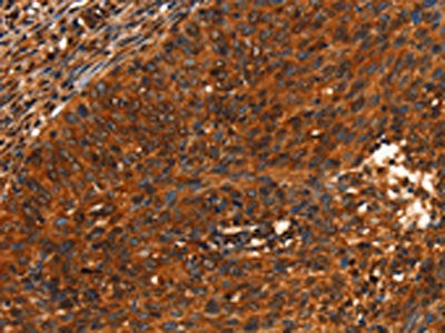 The image on the left is immunohistochemistry of paraffin-embedded Human cervical cancer tissue using the antibody Antibody) at dilution 1/40, on the right is treated with synthetic peptide. (Original magnification: ×200)Rabbit anti-Human PRKD1 Polyclonal Antibody