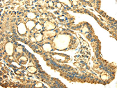 The image on the left is immunohistochemistry of paraffin-embedded Human thyroid cancer tissue using SDHA Antibody(SDHA Antibody) at dilution 1/40, on the right is treated with fusion protein. (Original magnification: ×200)Rabbit anti-Human SDHA Polyclonal Antibody