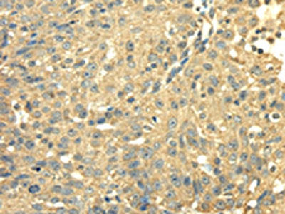 The image on the left is immunohistochemistry of paraffin-embedded Human breast cancer tissue using the antibody Antibody) at dilution 1/40, on the right is treated with fusion protein. (Original magnification: ×200)Rabbit anti-Human SDHA Polyclonal Antibody