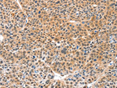 The image on the left is immunohistochemistry of paraffin-embedded Human lung cancer tissue using DDX4 Antibody(DDX4 Antibody) at dilution 1/20, on the right is treated with fusion protein. (Original magnification: ×200)Rabbit anti-Human DDX4 Polyclonal Antibody